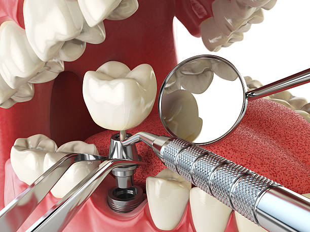 Best Urgent Tooth Repair  in Vilge St George, LA